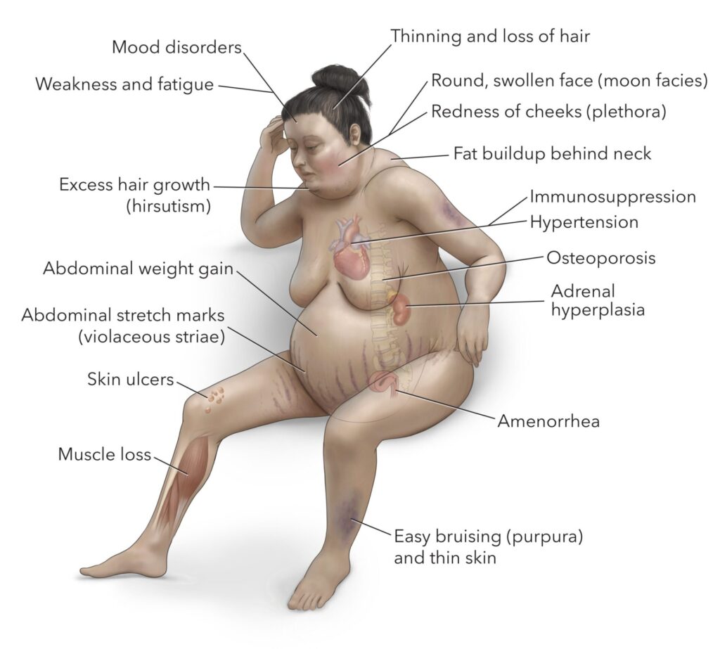 Cushings-syndrome